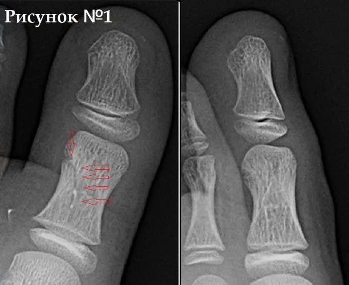 Fracture or crack? (why doctors do not recognize the diagnosis of fissure) - My, Fracture, Gypsum, Doctors, Emergency room, Traumatology, X-ray, The photo, Injury, The patients, Hospital, Polyclinic, The medicine, Nauchpop, Disease, Orthopaedist, Diagnosis, Treatment, Radiology