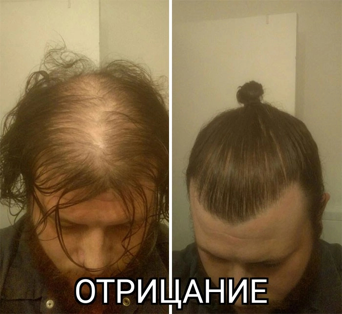 There are five stages of hair loss: - My, Стрижка, Humor, The hairdresser, Bald head, Longpost