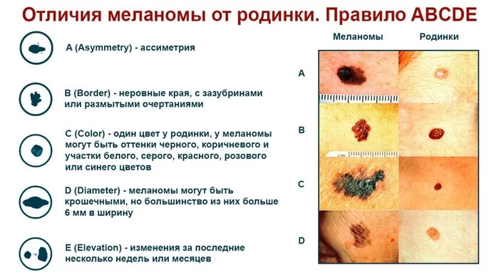 Как защитить себя? Часть 1: меланома - Моё, Рак и онкология, Медицина, Здоровье, Меланома, Профилактика, Ликбез, Длиннопост