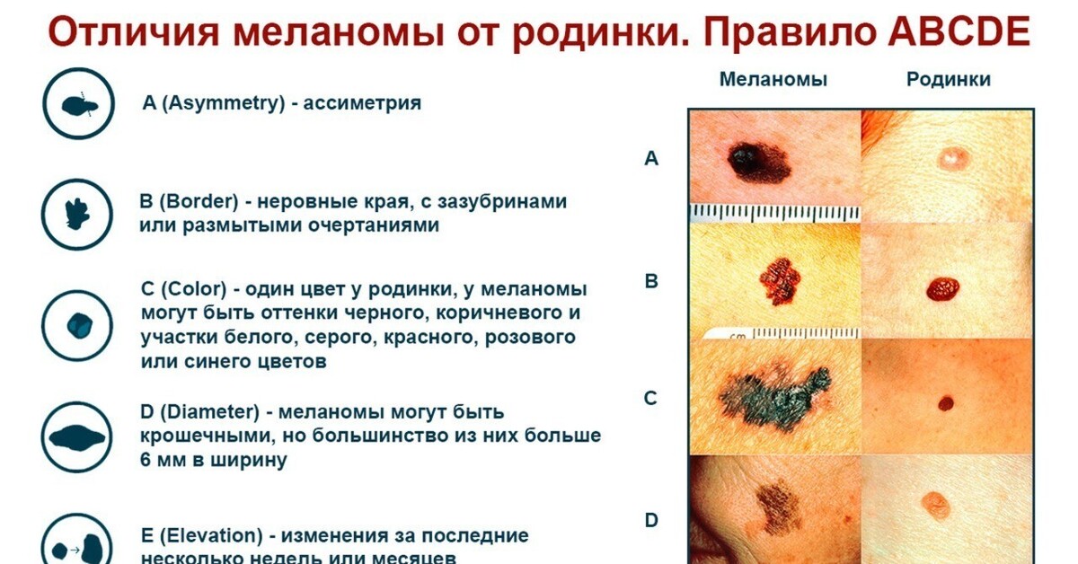 Эстетика или изъян? Звёзды c родинками на лице и теле