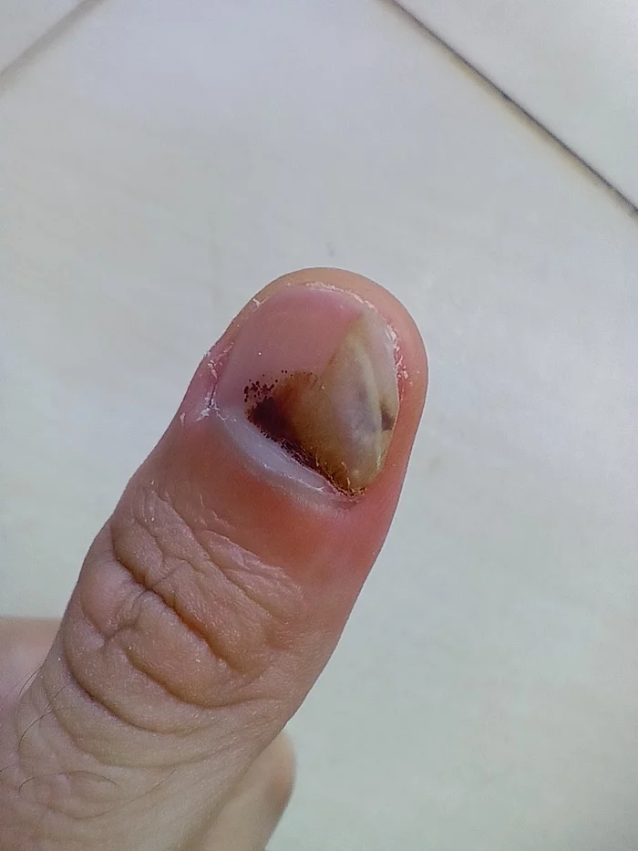 Damage to the nail plate. I ask for advice! - My, Fingers, Injury, Advice