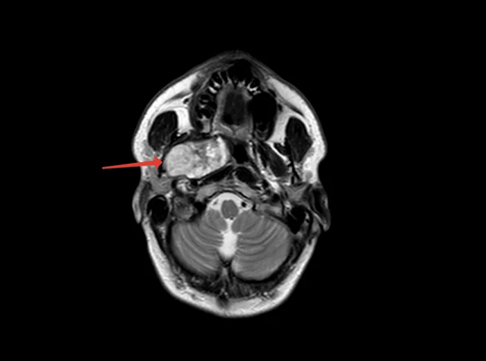 Pleomorphic adenoma (carcinoma) of the parotid salivary gland - My, The medicine, Disease history, Cancer and oncology, Disease, Treatment, Hospital, Operation, Tumor, Adenoma, Carcinoma, Blokhin Cancer Center, Longpost