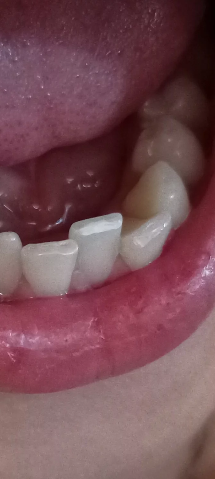 The dentist grinded off the enamel - My, Enamel, Tooth enamel, Dentist, Rukozhop, Teeth, Longpost
