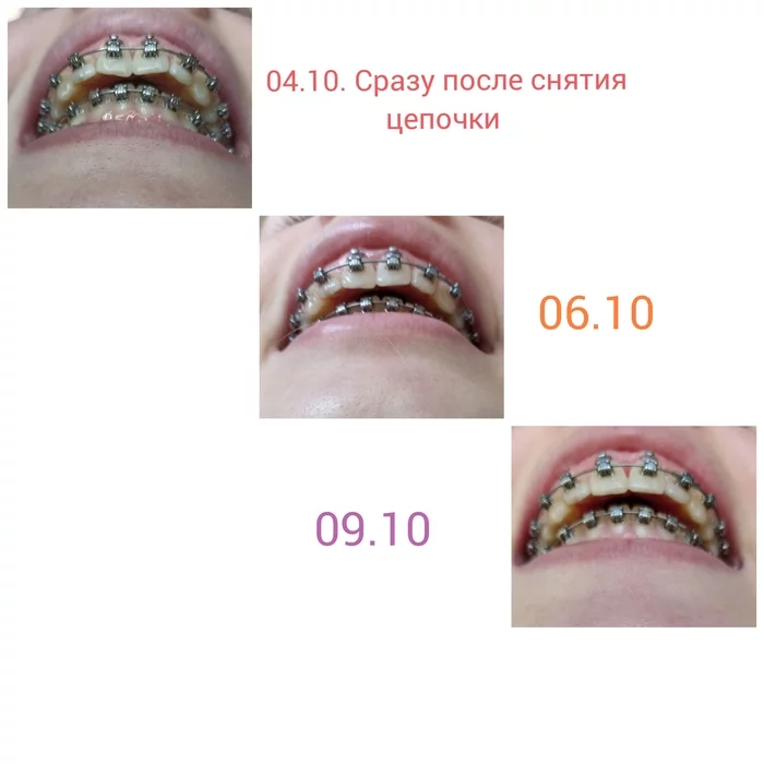 Correction of distal occlusion. My observations - My, Dylk, Bite correction, Malocclusion, Braces, Orthodontics, Maxillofacial Surgery, Treatment, Longpost