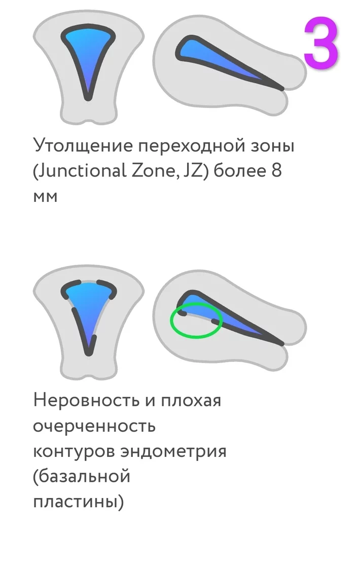 Аденомиоз или нет? - Моё, Гинеколог, Здоровье, Женщины, Длиннопост, Болезнь