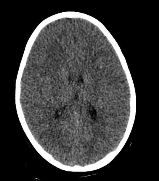 A case from radiological practice: an accident involving a child - My, Personal experience, Disease history, Road accident, Injury, CT, MRI, Radiology, Brain, Video, Longpost