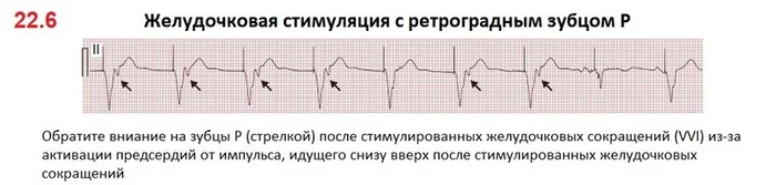 Pacemakers and Implantable Cardioverter-Defibrillators: Essentials for Clinicians. Part 2 - My, The medicine, Evidence-based medicine, Doctors, District doctor, ECG, Medical student, Higher education, Health, Hospital, Disease, Disease history, Treatment, Longpost