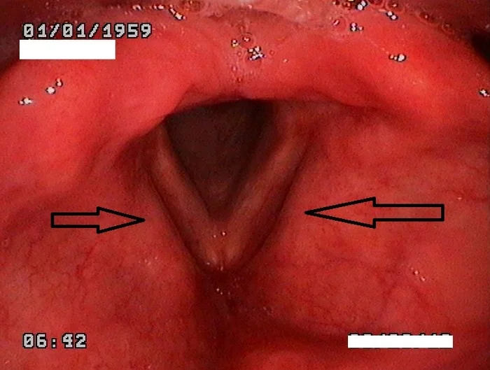 Endophotos. Part 4. Trachea and bronchi - My, The medicine, Endoscopy, Cancer and oncology, Bronchoscopy, Longpost