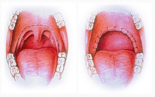 Snore. My struggle - My, Snore, Sipap, Health, Mat, Longpost