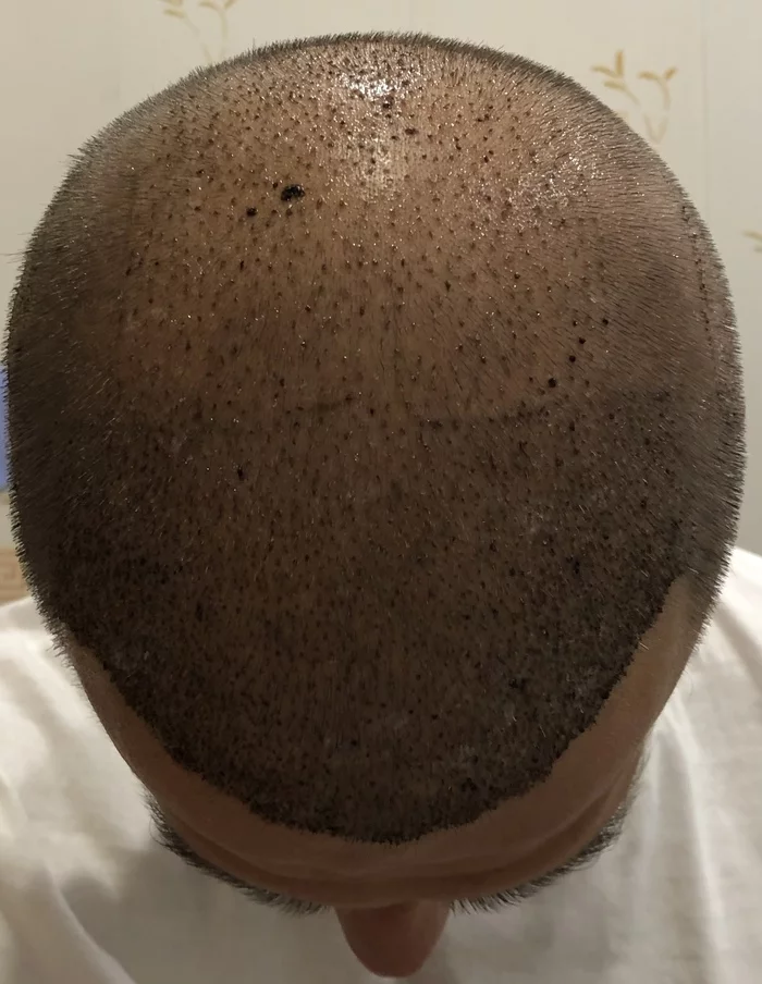 4 months after transplant - Hair Transplant, Joy, Mat, Longpost