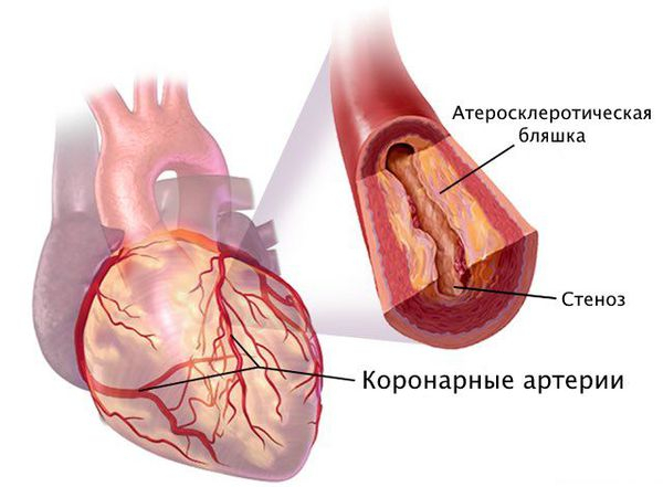 Медицина простым языком: Ишемическая болезнь сердца - Моё, Медицина, Доказательная медицина, Кардиология, Длиннопост