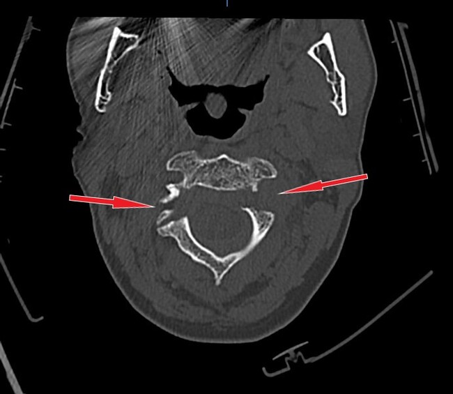 Cases from radiological practice: gallows fracture - My, Fracture of the spine, CT, Radiology, Video, Soundless, Longpost