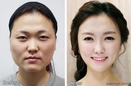 About the cult of beauty in South Korea - My, South Korea, Plastic surgery, Travels, Useful, Longpost