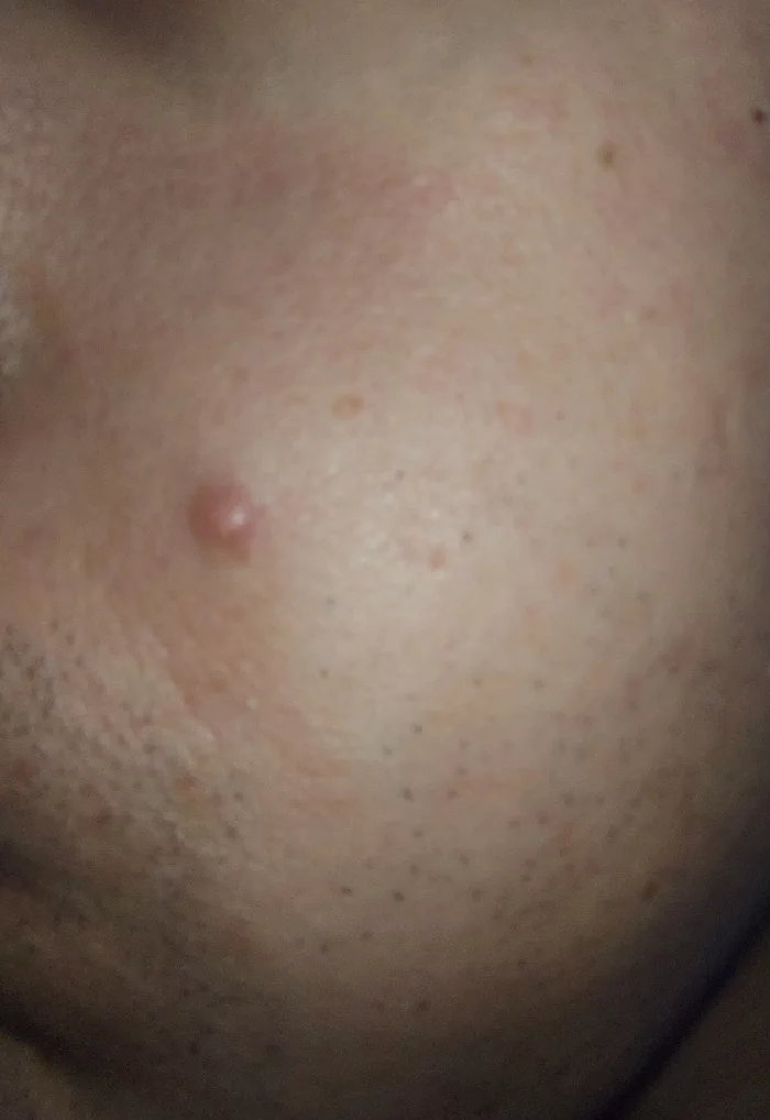 How to get rid of a purulent pimple? - How?, Help, What to do