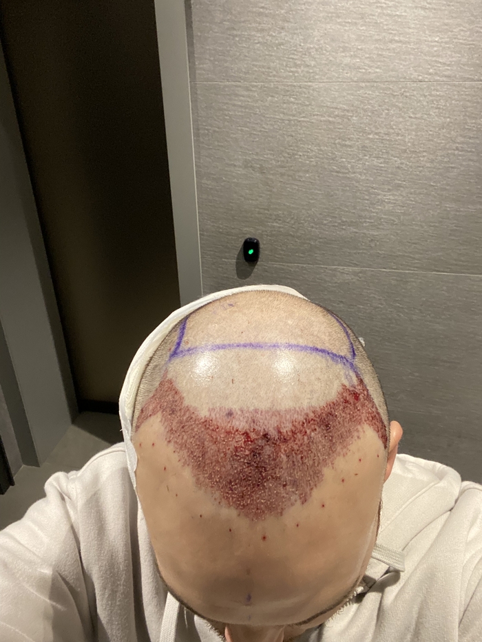 Пересадка волос в Турции Волосы, Пересадка волос, Турция, Длиннопост