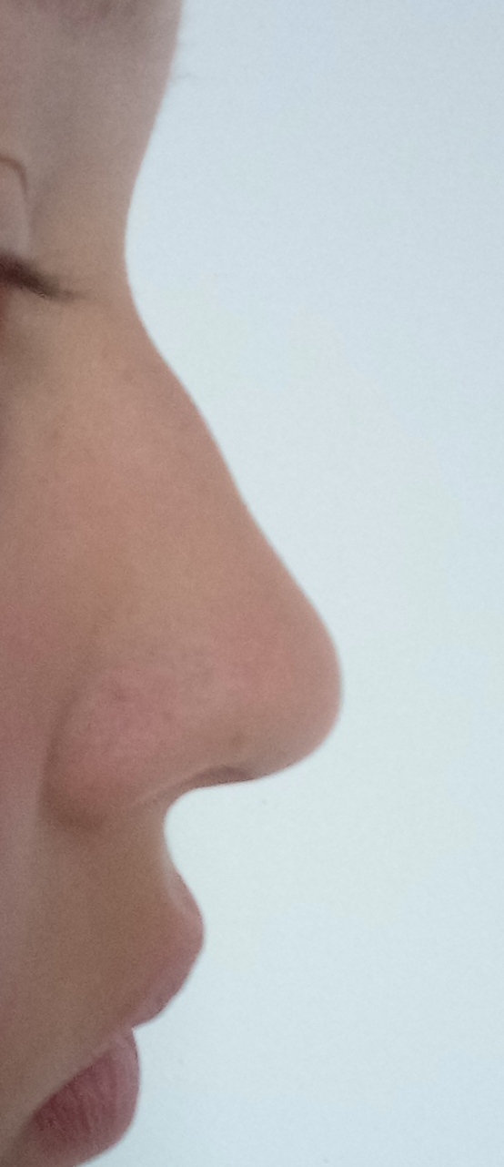Горбинка носа. Показания и противопоказания к операции