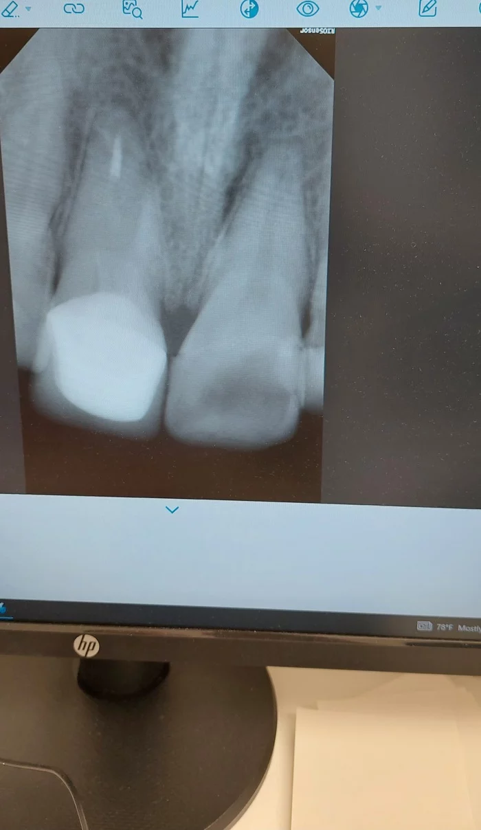 Tooth got sick - My, Teeth, Dentistry, Help