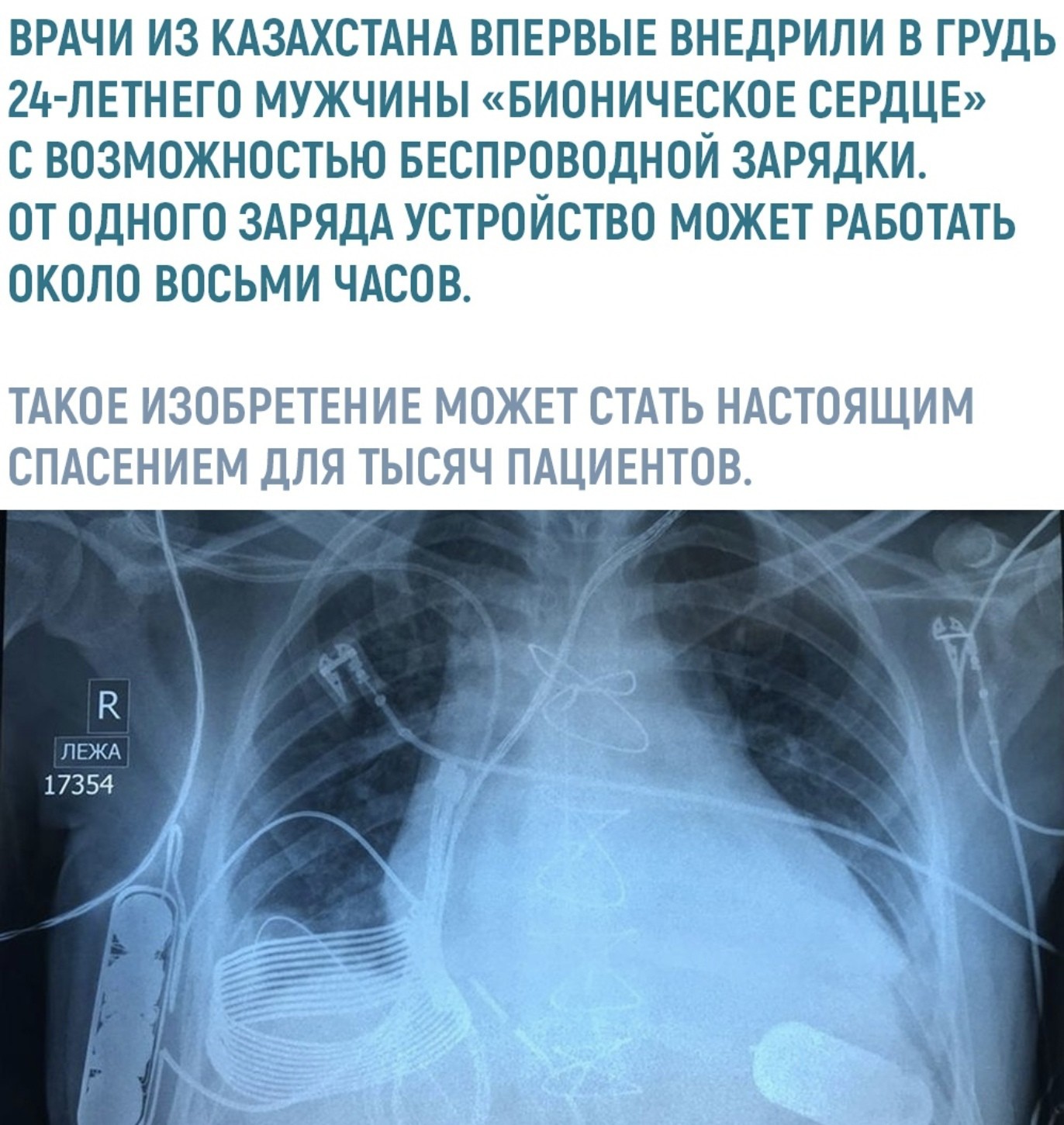 Bionic heart. - Bionic prosthesis, Kazakhstan, Doctors, The science