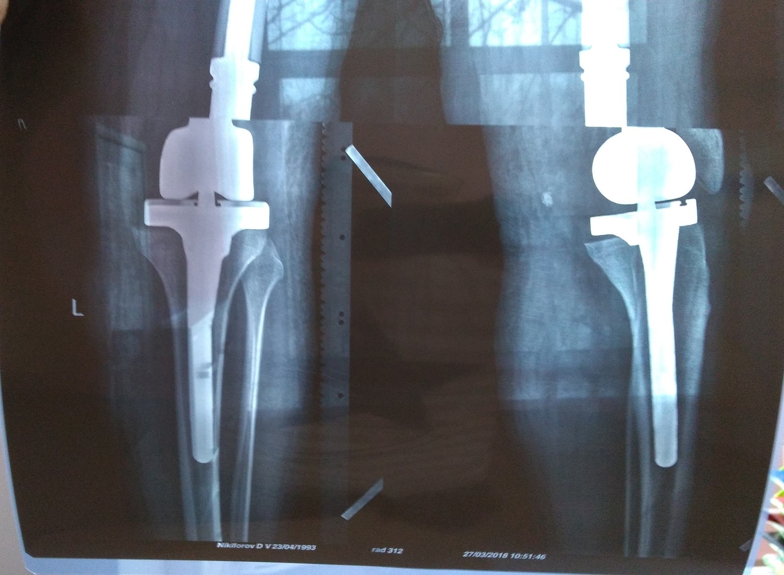 Endoprosthesis or how I became a cyborg! - My, Endoprosthetics, Sarcoma, Joints, The medicine, Longpost, Text