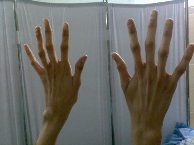 Arachnodactyly (literally spider fingers) - Pathology, Anatomy, Longpost