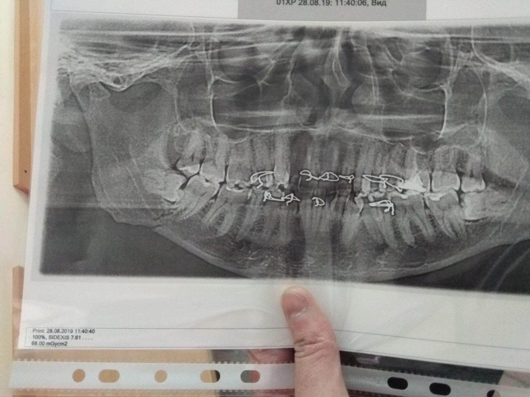 How do I remove my wisdom tooth? - My, Dentist, Wisdom tooth, Jaw fracture, Longpost