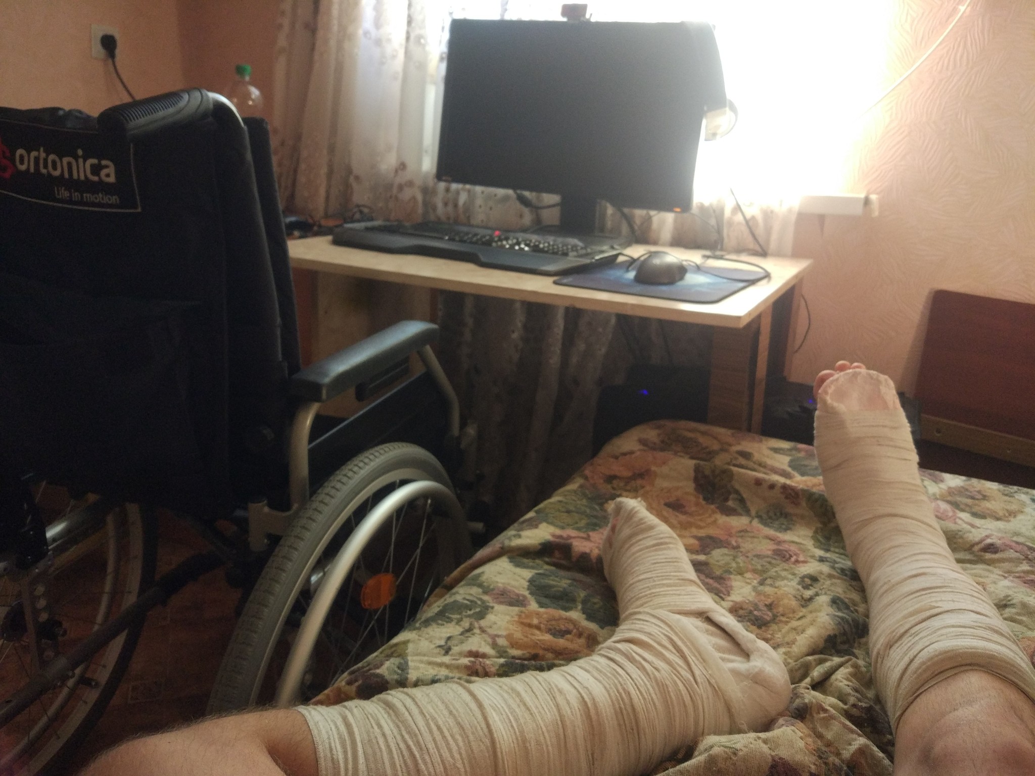 Briefly about how I spent the summer - My, Fracture, End of summer, Legs, Summer