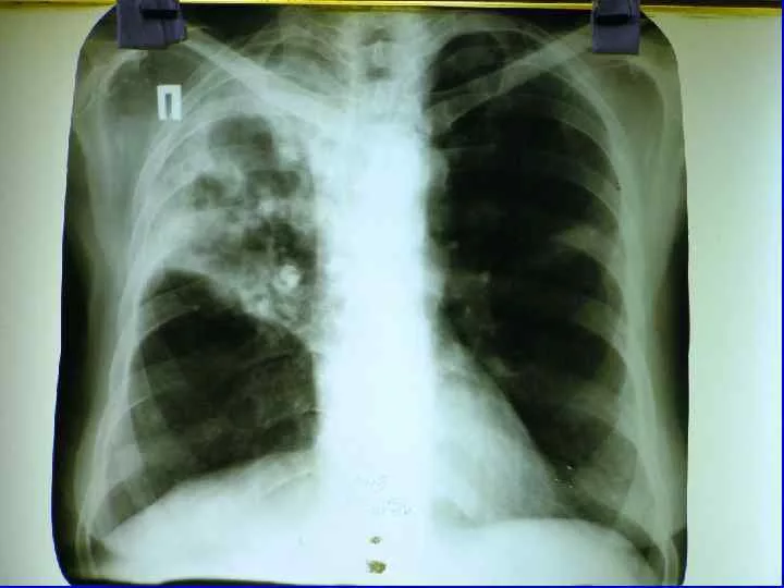 Tuberculosis - My, The medicine, Tuberculosis, Hyde, Mat, Longpost