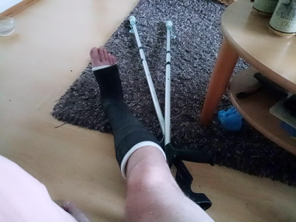 And how was your weekend? - My, Broken leg, Fracture, Gypsum, Finland