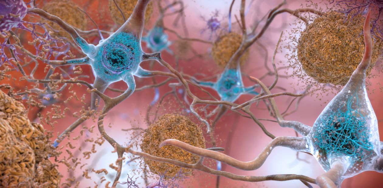 Another trial of a new drug for Alzheimer's disease was successful - Alzheimer's disease, Intelligence, Clinical trials, news