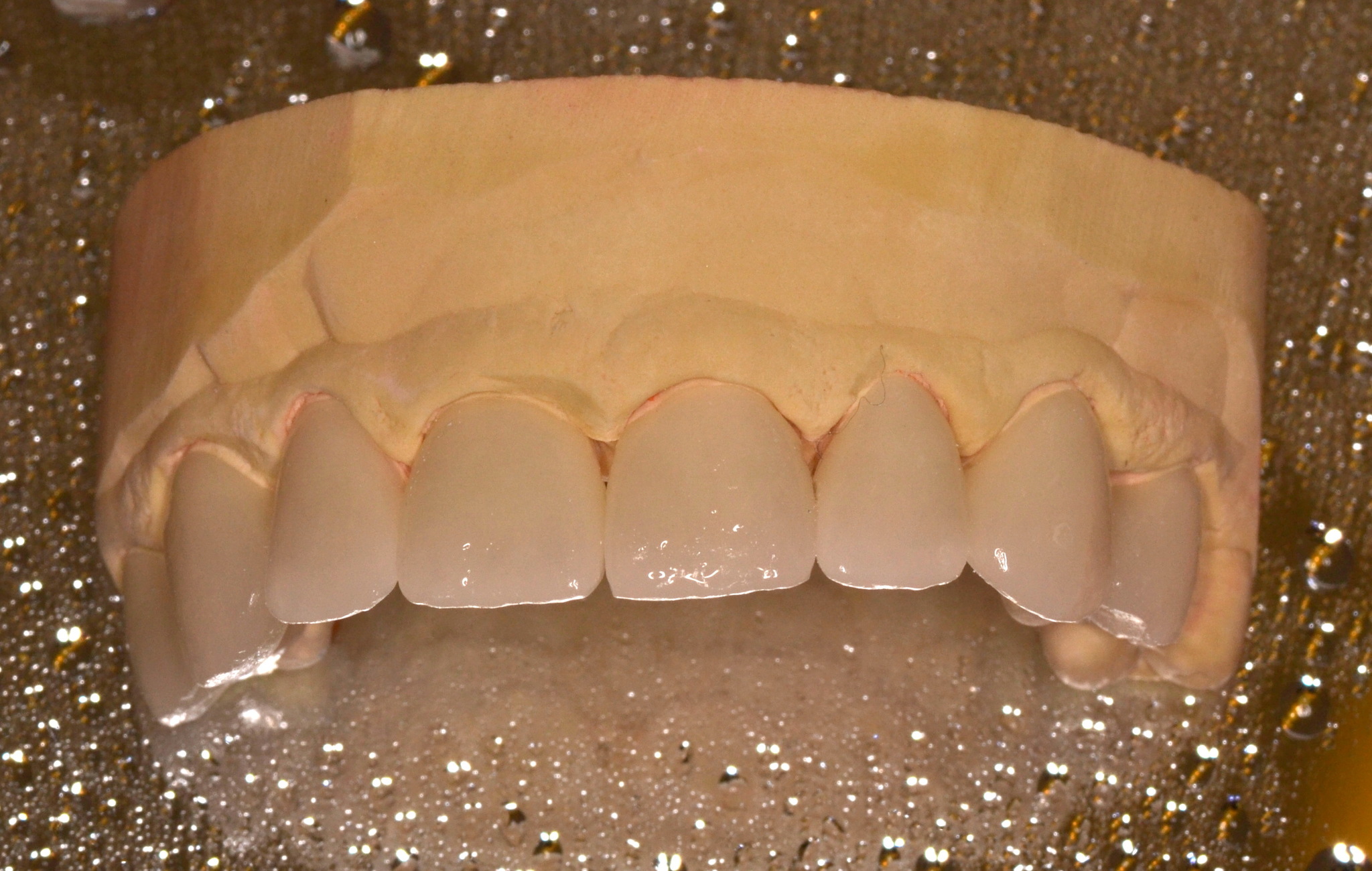 Will beauty save the world? about veneers... - My, Teeth, Veneers, Smile, Dentistry, Longpost