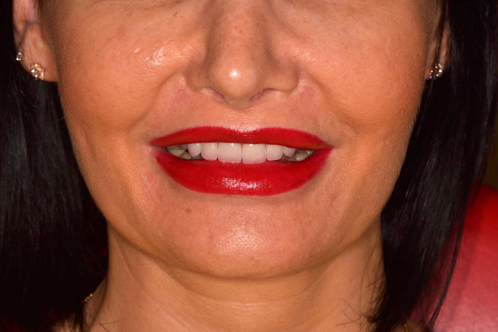 Will beauty save the world? about veneers... - My, Teeth, Veneers, Smile, Dentistry, Longpost