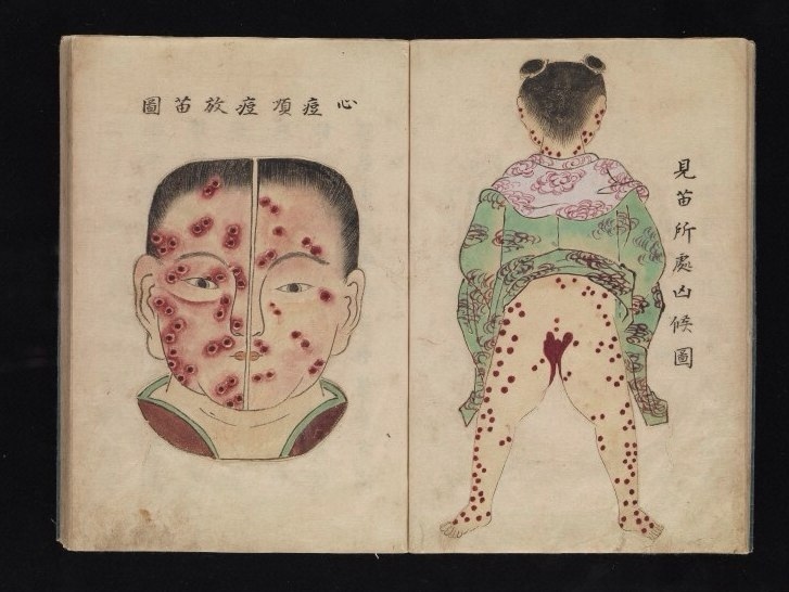 Unique three-dimensional medical atlas of the Japanese doctor Kanda Gensen, late 17th century - Old books, Japan, The medicine, Trypophobia, Longpost, Smallpox