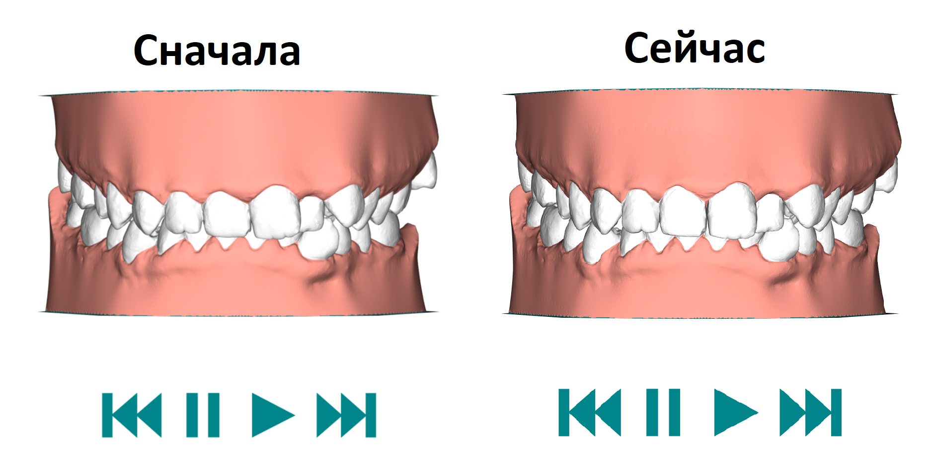 Aligners. First year - My, Aligners, Bite correction, Malocclusion, Personal experience