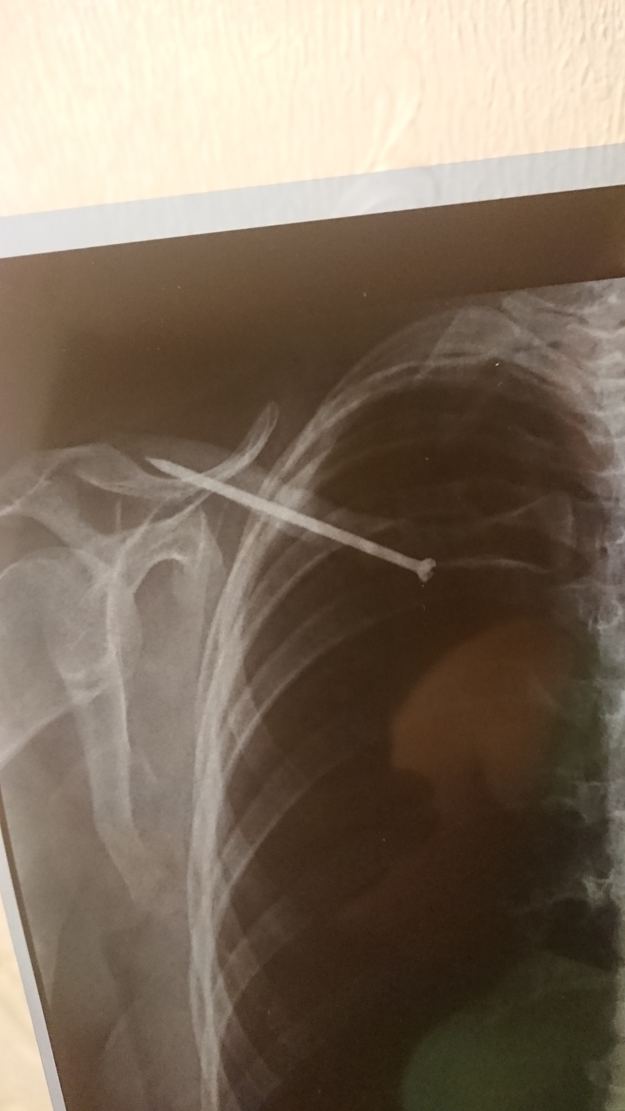 Who lives with titanium? - My, Osteosynthesis, Operation, Fracture, Titanium, Longpost