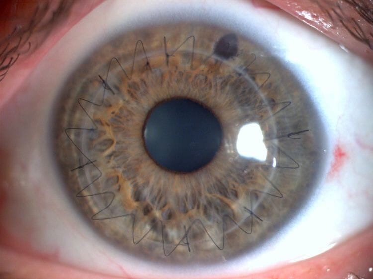 Suture after corneal transplant surgery - Eyes, Operation, Longpost