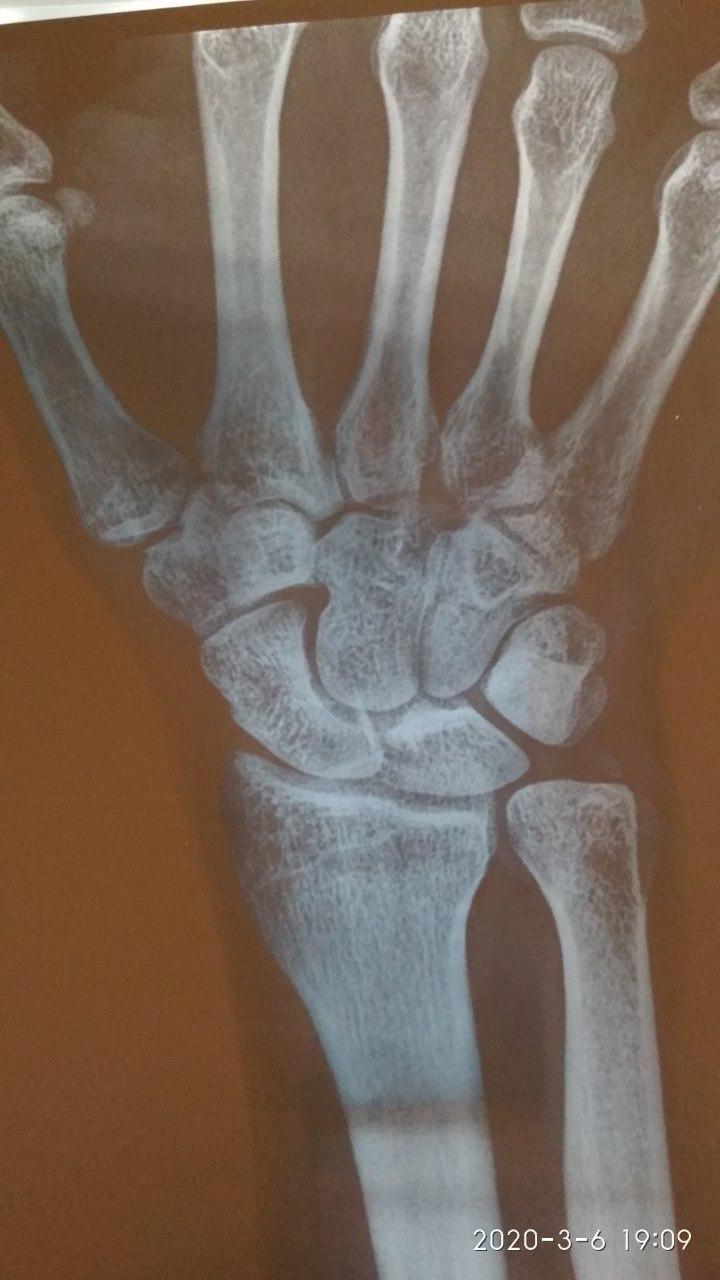 Fracture. Hand. Ice - My, The medicine, Fracture, Surgeon, Traumatology, Doctors, Doctor, Longpost