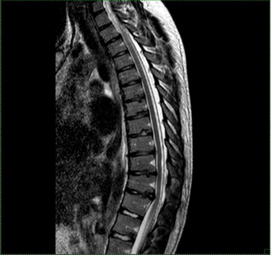 Increased kyphosis, spinal curvature - My, Spine, Thoracic spine, Kyphosis, Health, Depression, Appearance, Longpost, Disease