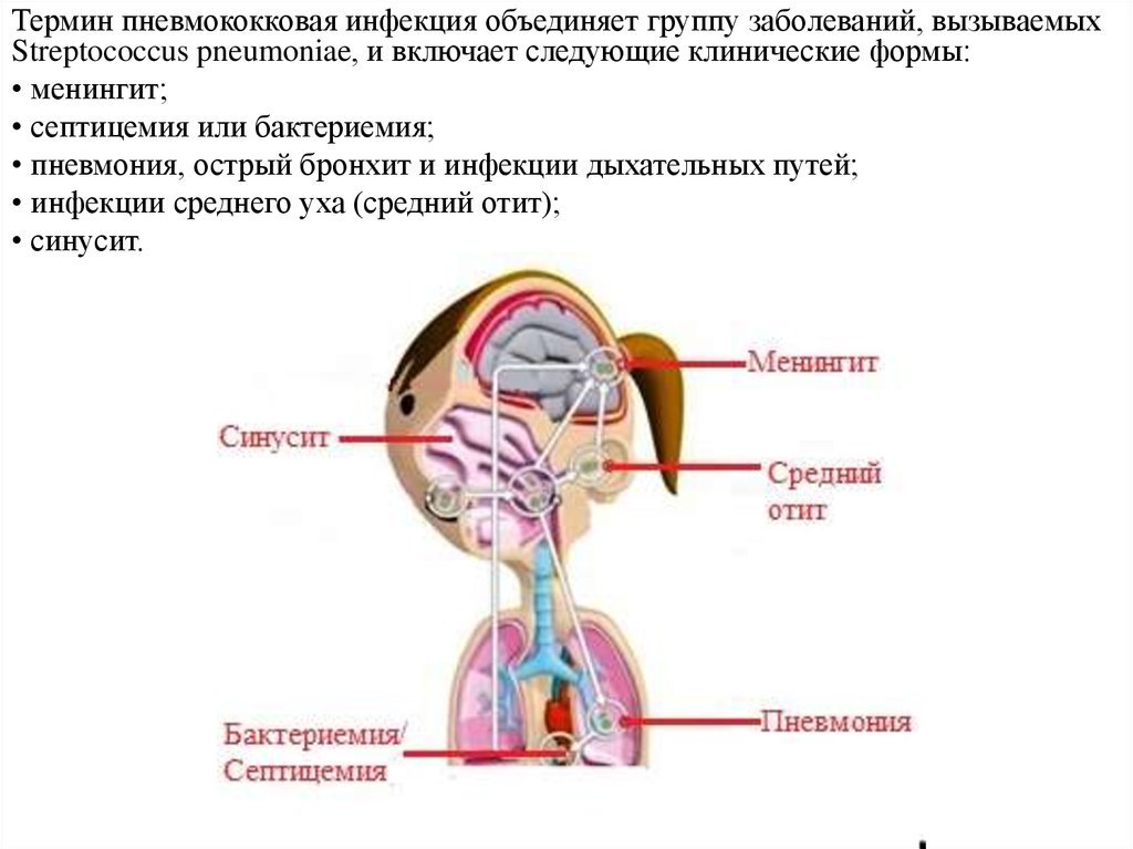 There are different types of pneumococci - Vaccine, Vaccination, Health, Longpost