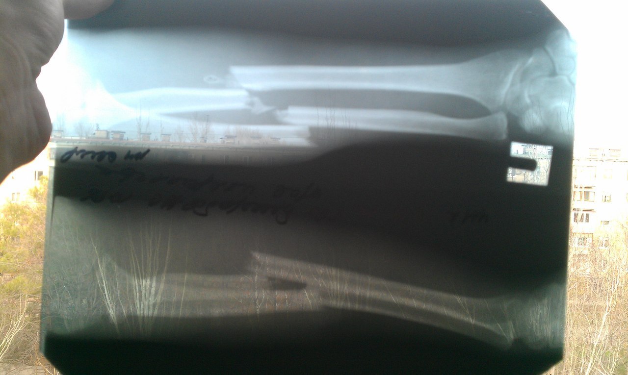 Defect after a fracture of the right forearm - Broken arm, Doctors need help, Longpost