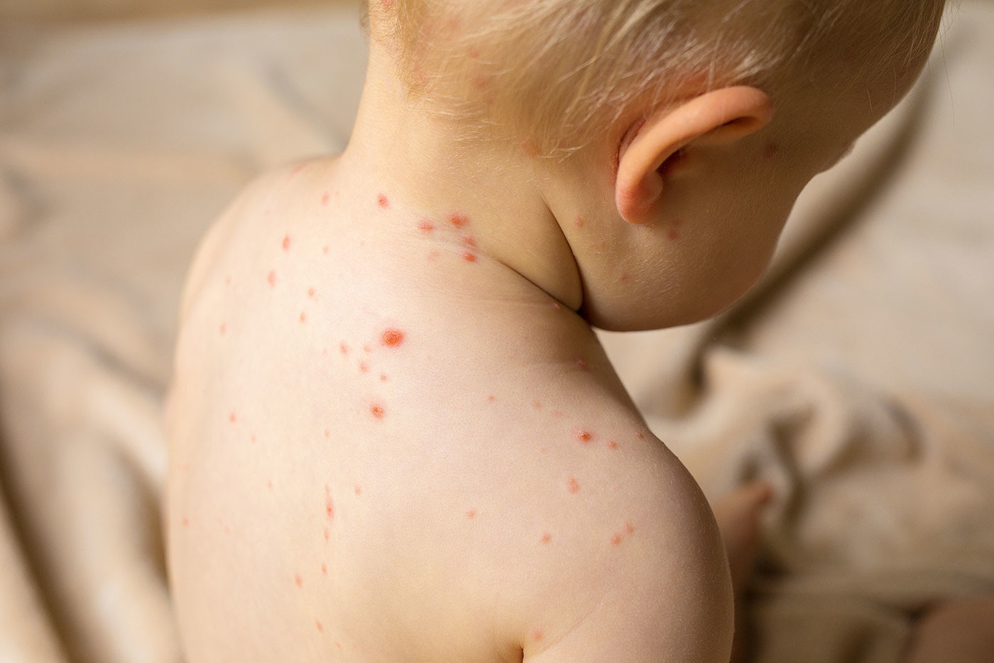 How adults and children get measles - Measles, , Vaccine, Children, The medicine, Health, Longpost, Infection