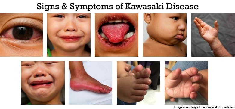 Kawasaki syndrome and what you need to know about it - Kawasaki syndrome, Symptoms, Video, Longpost