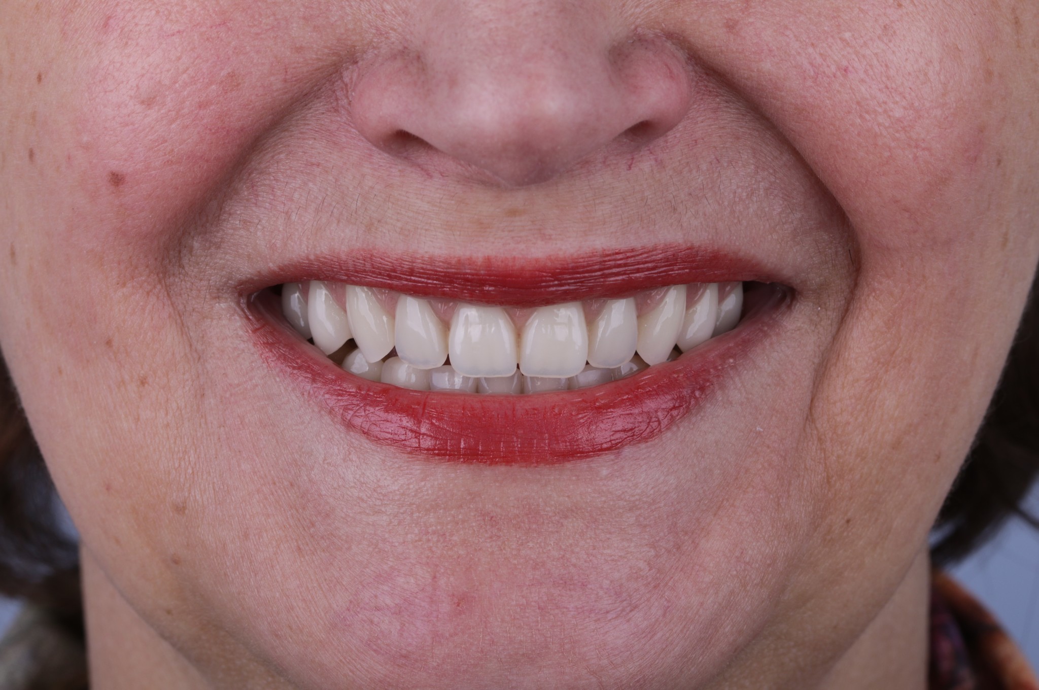 Люди с имплантами зубов