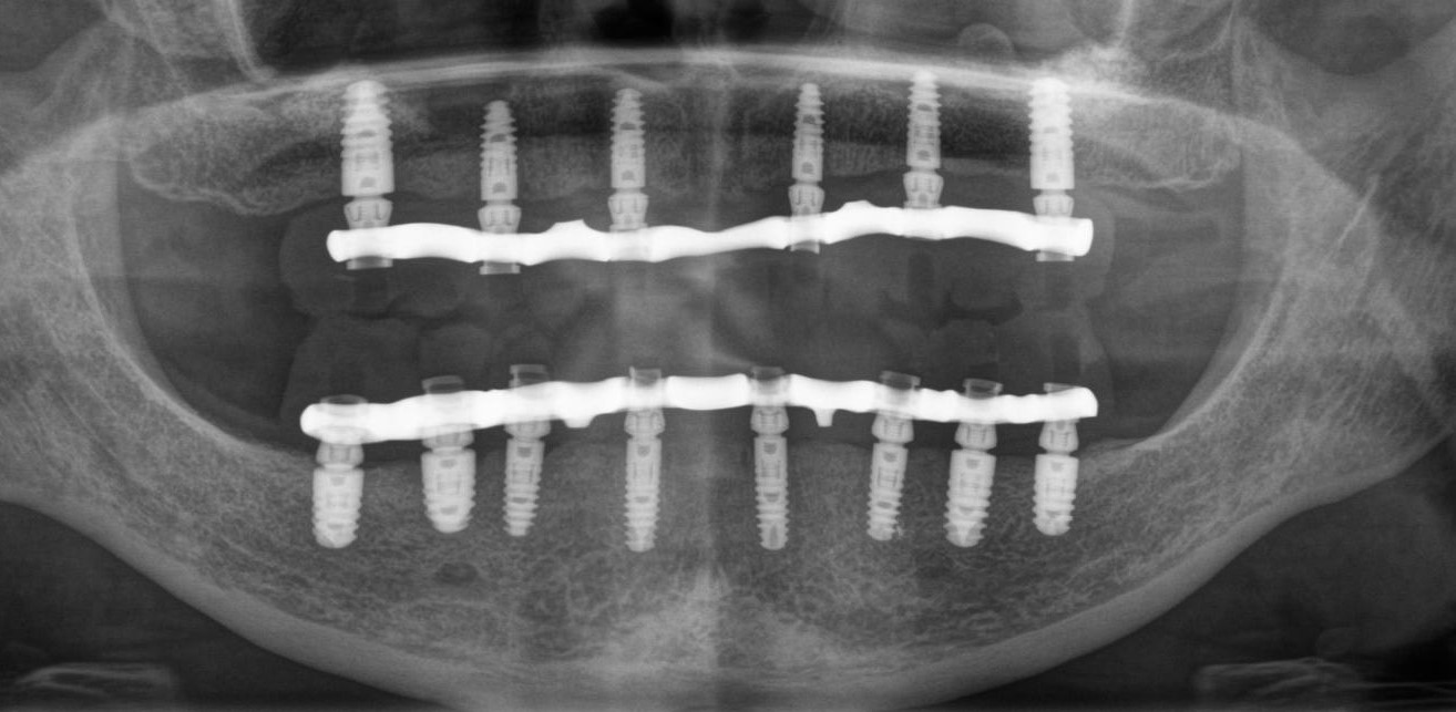 Total prosthetics on implants - My, Dentist, Dentistry, Implantation, Dental implantation, Extraction of teeth, Teeth, Doctors, Longpost