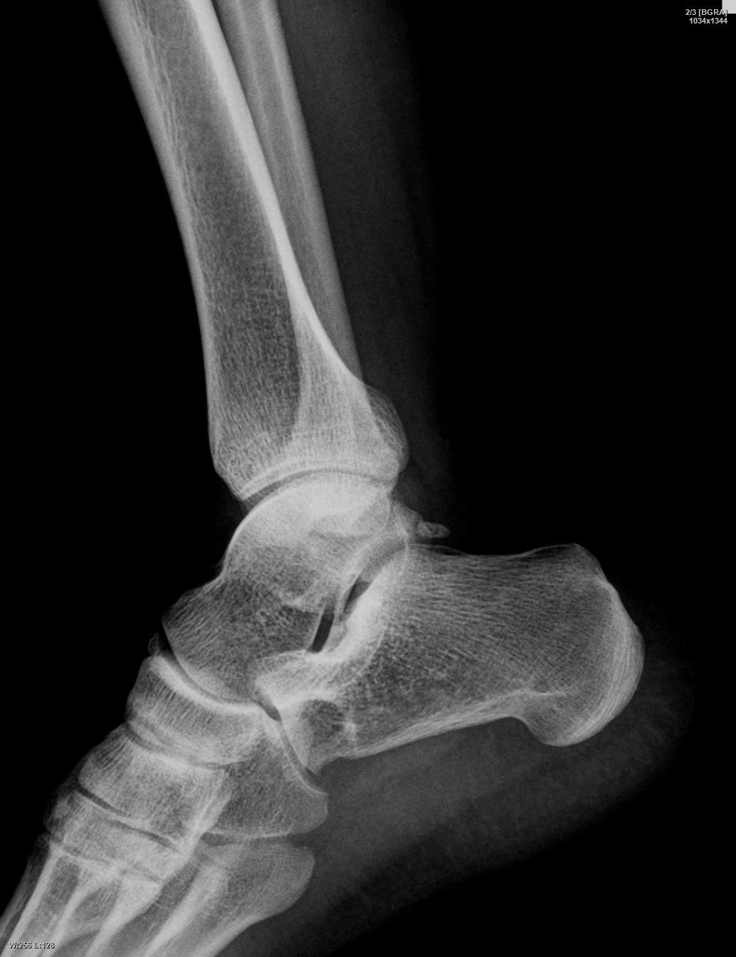 Old apical avulsion of the lateral malleolus - My, Injury, The medicine, Orthopaedist, Advice, Doctor, Longpost