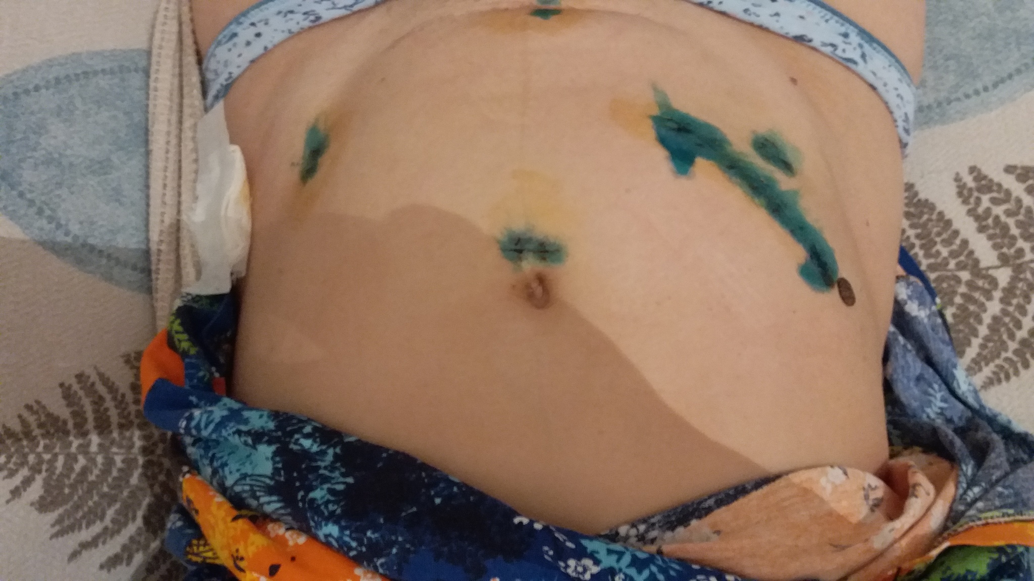 шрам от пирсинга после беременности | Дзен