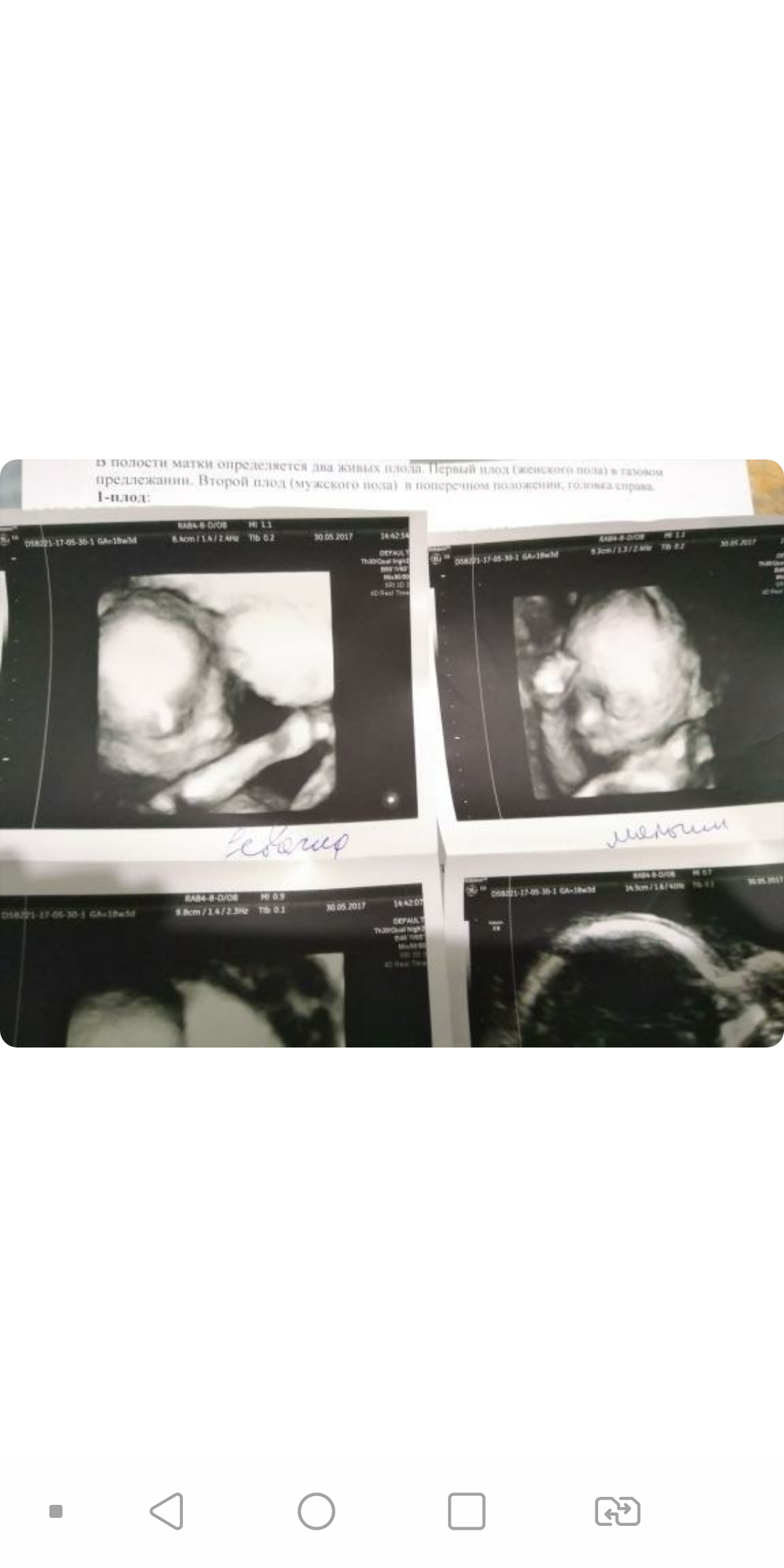 The story of one non-abortion - Twins, Abortion, Gynecologist, Ultrasound, Longpost