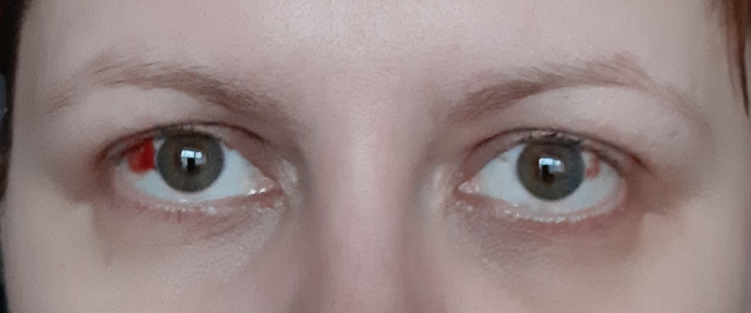 капли при светобоязни глаз. отзывы после ласика коррекции. отзывы после ласика коррекции. сетчатка глаза. лазерная коррекция методом фемто ласик.