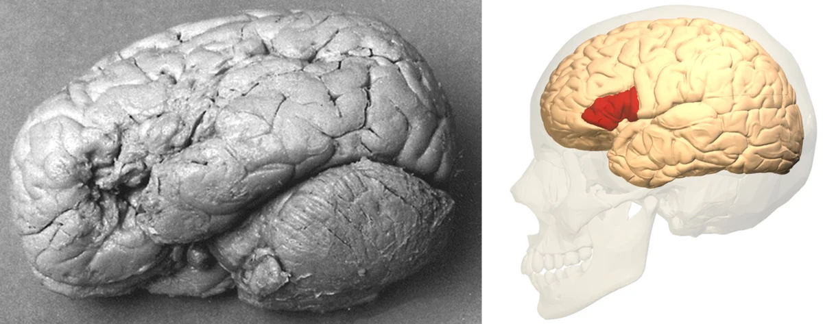 Why has the expression “on the tip of your tongue” become a real horror for some? - My, Biology, Neurobiology, The medicine, Speech, The science, Nauchpop, Brain, Disease history, Disorder, Injury, Brock, Scientists, A life, Video, Longpost