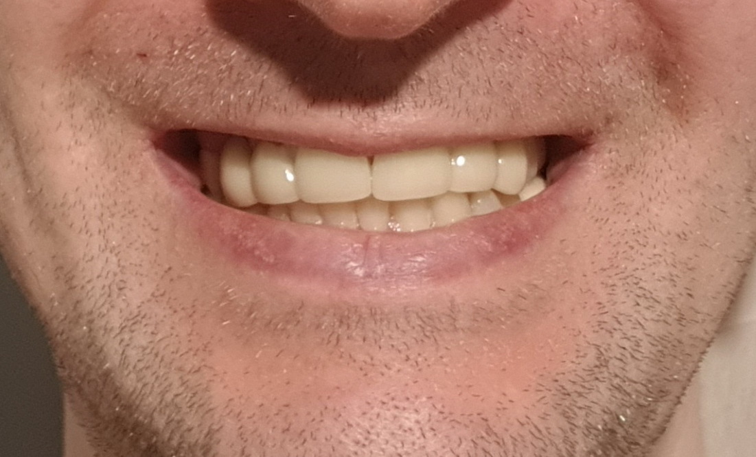 What you will have to face during implantation - My, Teeth, Prosthetics, Implants, Dentistry, Mat, Longpost