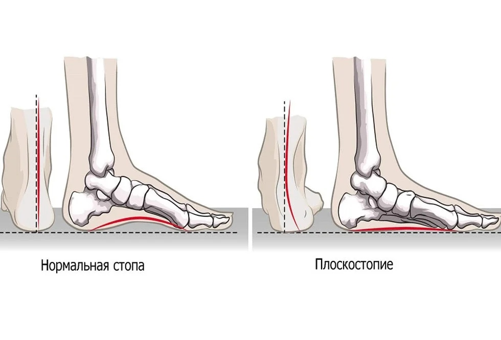 НОРМАЛЬНАЯ СТОПА - Моё, Плоскостопие, Ноги